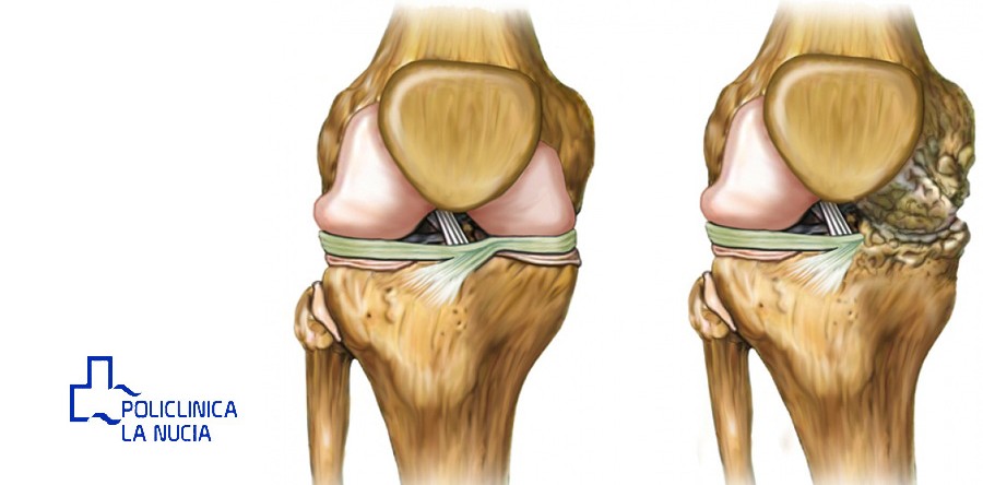 Qué es la Artrosis y cuál es su tratamiento